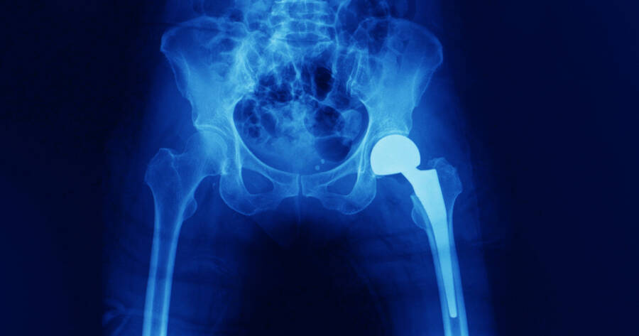 What to Know About Class Action Suits for Hip Replacement Before Filing